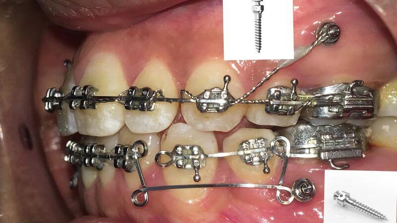 Tháo vít niềng răng có đau không? Tiêu chí để được tháo vít niềng răng 2