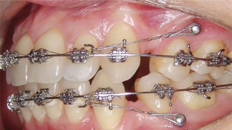 Tháo vít niềng răng có đau không? Tiêu chí để được tháo vít niềng răng 1
