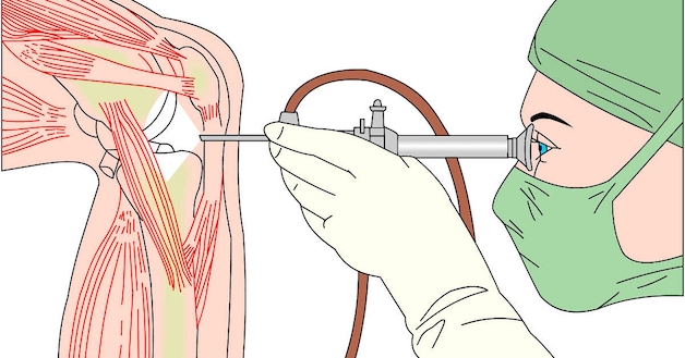 Thay khớp gối: Chỉ định thực hiện, quy trình và biến chứng sau phẫu thuật 4