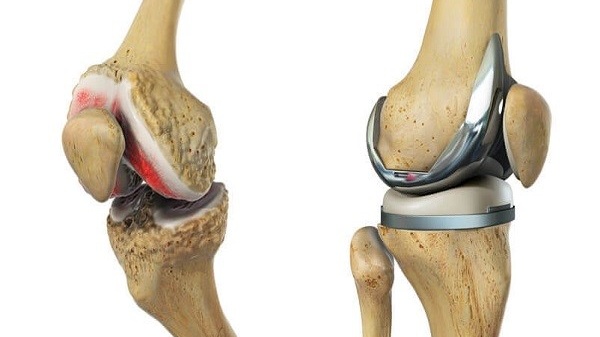 thay-khop-goi-giong-truc-dong-hoc-la-gi-nhung-dieu-can-biet 1