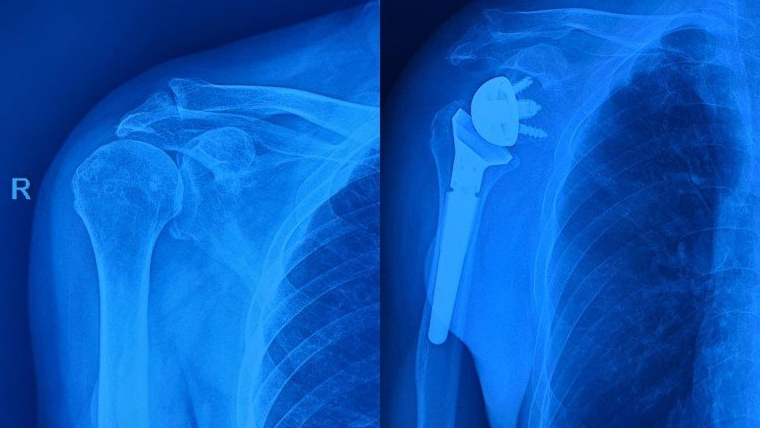 thay-khop-vai-la-gi-khi-nao-can-thuc-hien-phau-thuat-thay-khop-vai 1.jpg