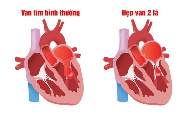 Thay van hai lá ở bệnh viện nào tốt nhất? 2