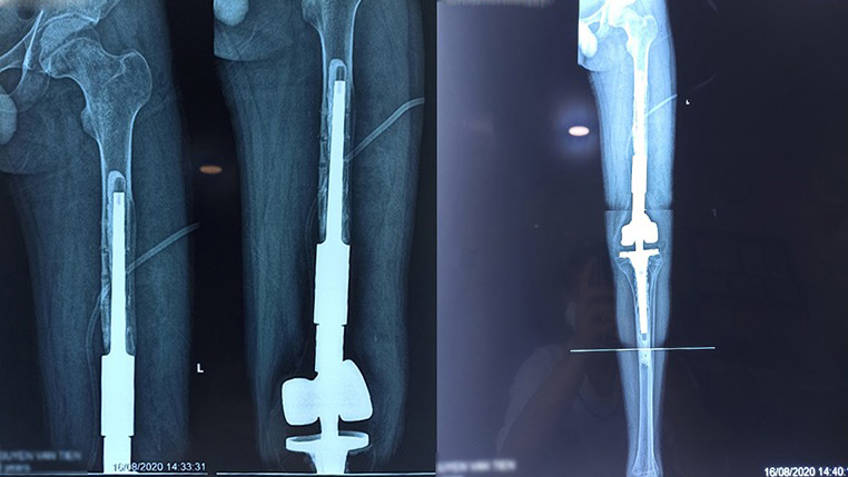 Thay xương đùi toàn bộ và những điều cần biết 1