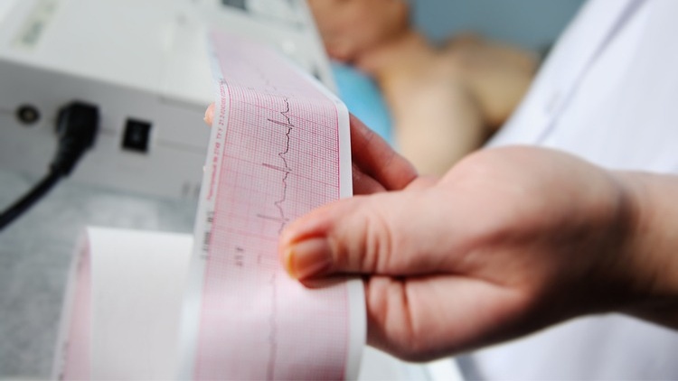 Thể hiện điện tâm đồ nhồi máu cơ tim có gì đặc biệt? 1