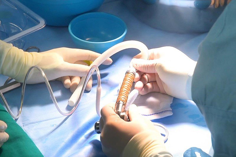 thiết bị tim cấy ghép 1