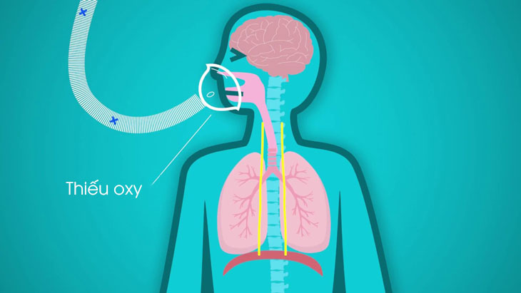Thiếu oxy khi ngủ là gì? Nguyên nhân thiếu oxy khi ngủ 3