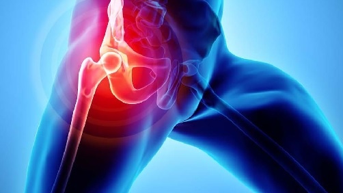 Thoái hóa khớp háng có chữa được không? Mức độ nguy hiểm của thoái hóa khớp háng 1