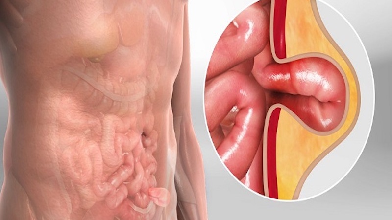 Nguyên nhân và cách điều trị thoát vị bẹn ở người lớn 1