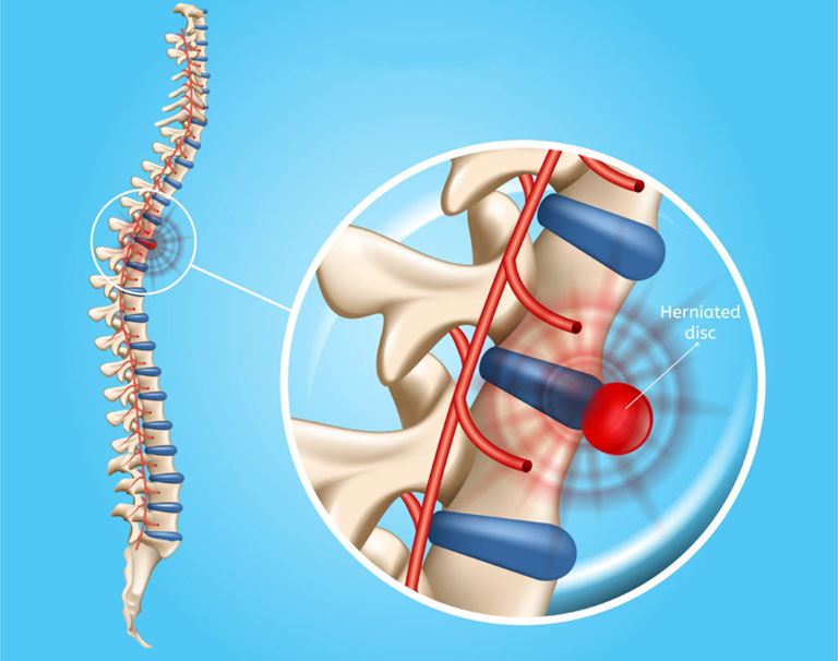 Thoát vị đĩa đệm có nên mổ không? Cách chăm sóc người bệnh thoát vị đĩa đệm sau phẫu thuật 1