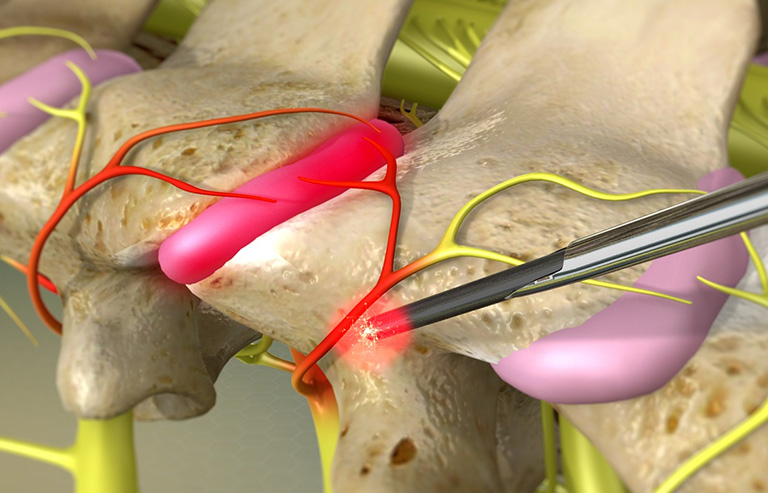 Thoát vị đĩa đệm ở người trẻ tuổi có nguy hiểm không? 2