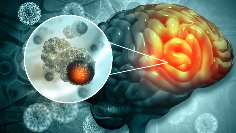 Thoát vị não là gì? Những vấn đề cần biết về Thoát vị não 2.png