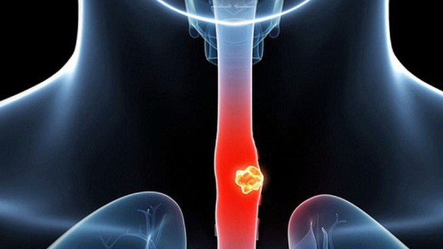 Thực quản: Chức năng và bệnh lý thường gặp 4