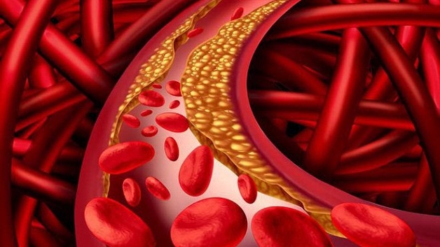 Thuốc chống đột quỵ là những loại thuốc nào? Cần lưu ý gì khi dùng thuốc chống đột quỵ? 3