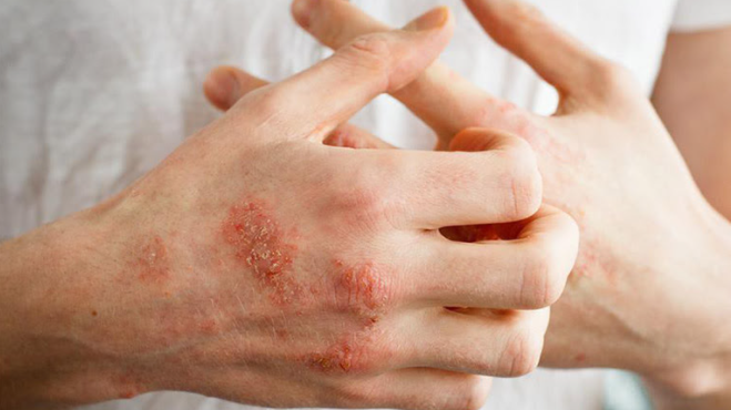 Thuốc trị ghẻ phỏng thường sử dụng hiện này là những loại nào? 2