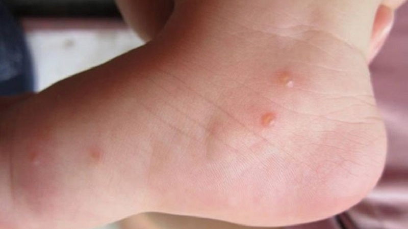 Thuốc trị ghẻ phỏng thường sử dụng hiện này là những loại nào? 3