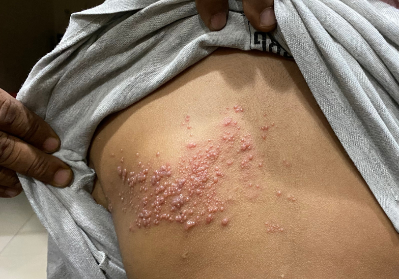 Thủy đậu bị mấy lần trong đời? Giải đáp thắc mắc về bệnh thủy đậu 2