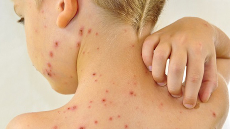 Thủy đậu có ngứa không? Những điều cần lưu ý khi bị thuỷ đậu 2