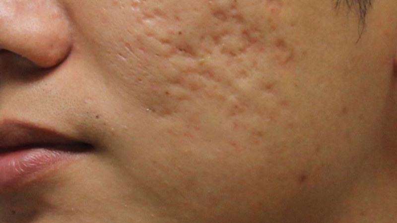 Thủy đậu có ngứa không? Những điều cần lưu ý khi bị thuỷ đậu 3