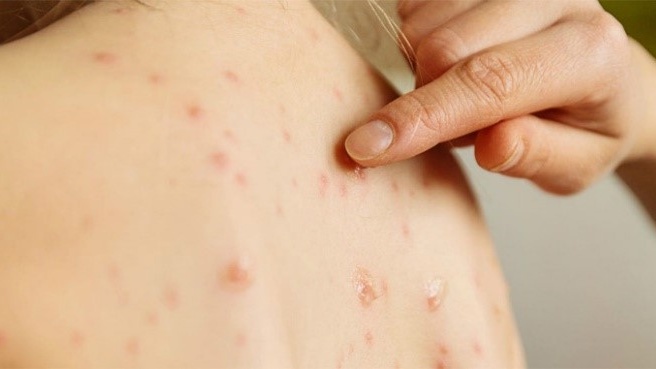 Thủy đậu có ngứa không? Những điều cần lưu ý khi bị thuỷ đậu 4