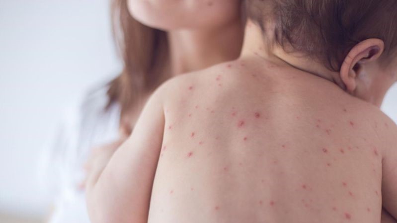 Thủy đậu tắm lá gì nhanh khỏi? Mách mẹ 5 loại lá hiệu quả tắm bé bị thủy đậu 3