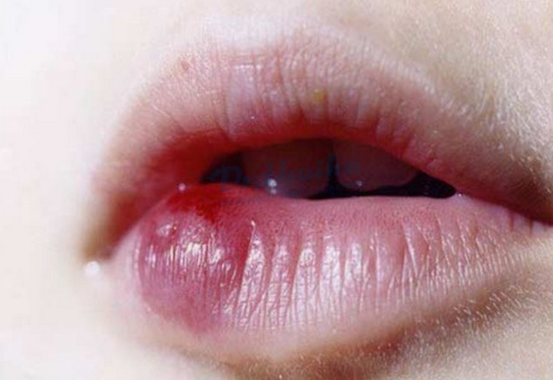 Tiêm filler bị vón cục có nguy hiểm không? Cách khắc phục 1