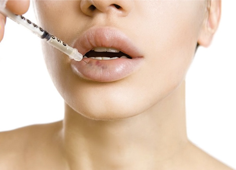 Tiêm filler bị vón cục có nguy hiểm không? Cách khắc phục 2