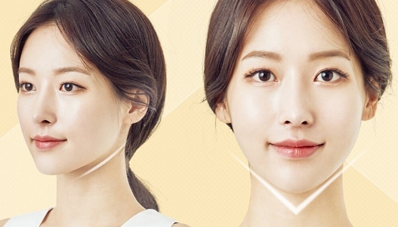 Tiêm filler cằm cần bao nhiêu cc? 1