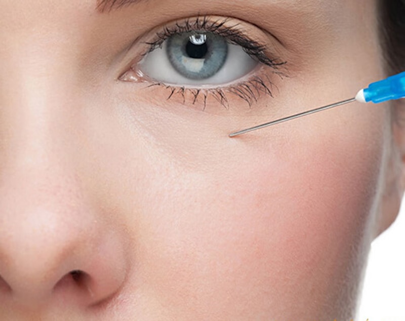 Tiêm filler hốc mắt có nguy hiểm không? Những thông tin cần biết 1