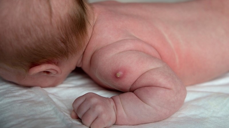 Tiêm lao khi nào? Thời điểm vàng bảo vệ sức khỏe trẻ sơ sinh 2