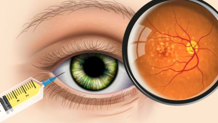 Tiêm nội nhãn là gì? Khi nào cần thực hiện? 1