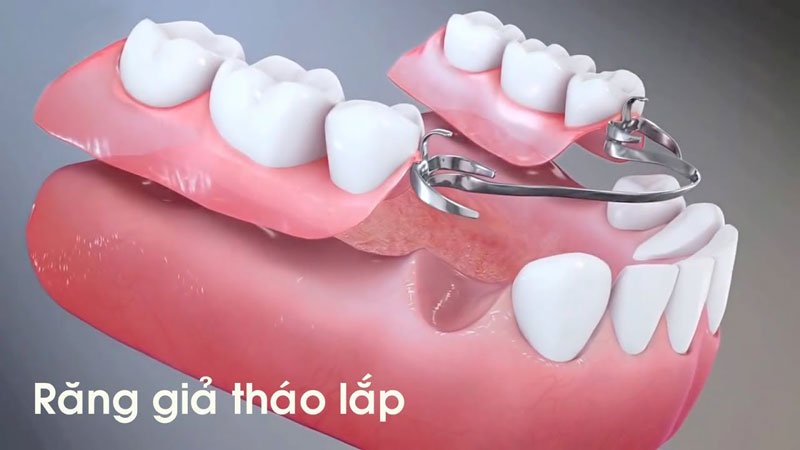 Tìm hiểu các phương pháp trồng răng phổ biến hiện nay 2