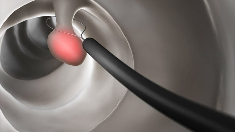 Tìm hiểu mổ u đại tràng có nguy hiểm không và phương pháp mổ 3