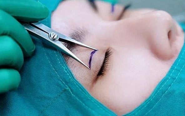 Tìm hiểu ngay về các phương pháp phẫu thuật nâng cơ mí mắt 2