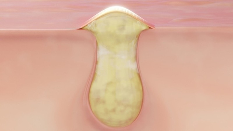 Tìm hiểu phác đồ điều trị lao hạch mới nhất 4