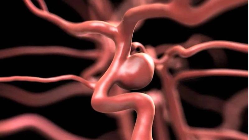 Cách điều trị phình mạch máu não​ hiệu quả và an toàn 2