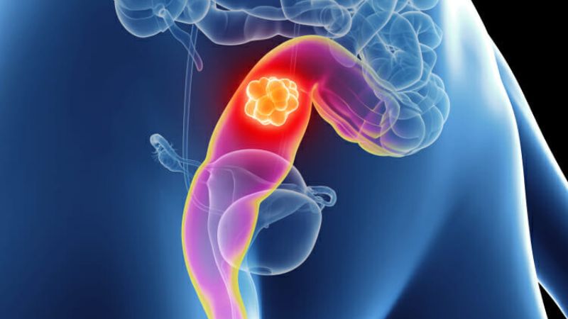 Tìm hiểu ung thư trực tràng sống được bao lâu? 1