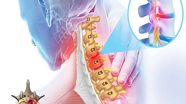 7 đốt sống cổ 01