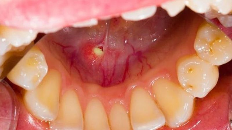 Tìm hiểu về bệnh lý sỏi tắc nghẽn ống wharton 1