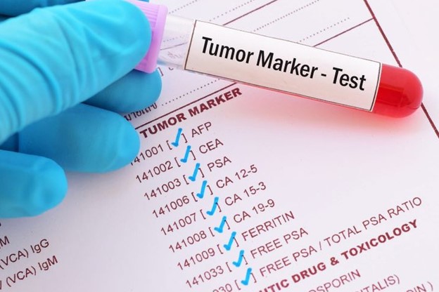 Tìm hiểu về các loại xét nghiệm dấu ấn ung thư thường được sử dụng 2
