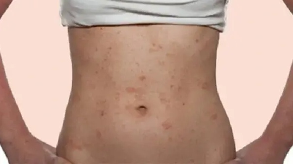 Tìm hiểu về điều trị nổi mụn ở bụng như thế nào? 3