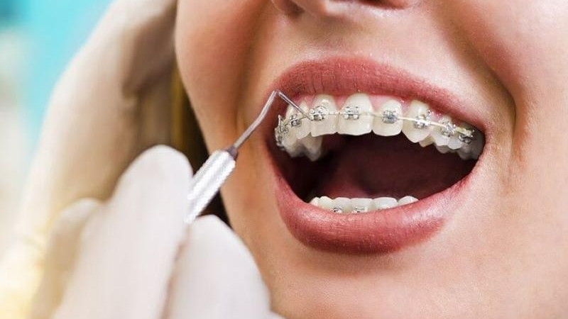 Tìm hiểu chi tiết về loop đóng khoảng răng cửa ở người