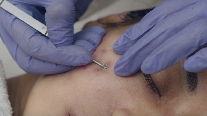 Tìm hiểu về phác đồ điều trị mụn chuẩn y khoa 1