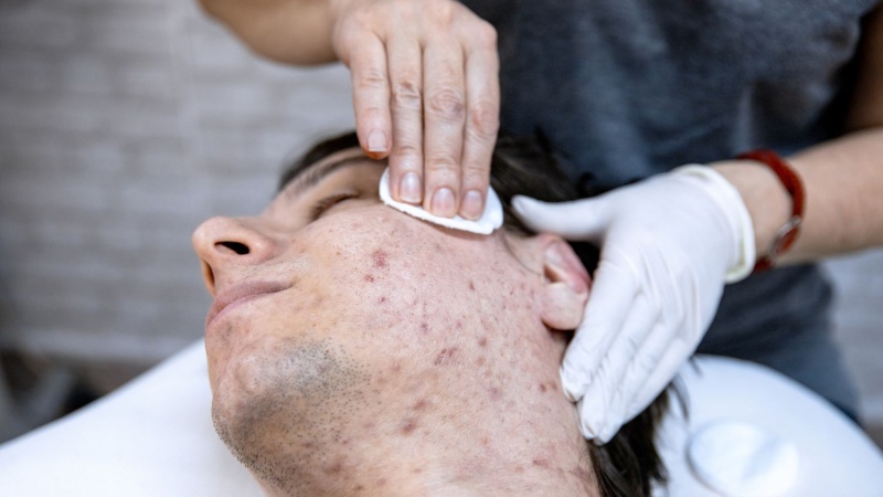 Tìm hiểu về phác đồ điều trị mụn chuẩn y khoa 2