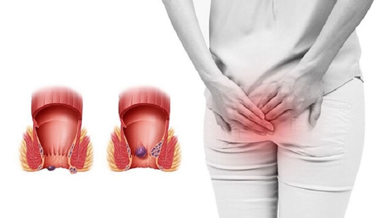 Tìm hiểu về tình trạng bị lòi dom sau khi sinh 1