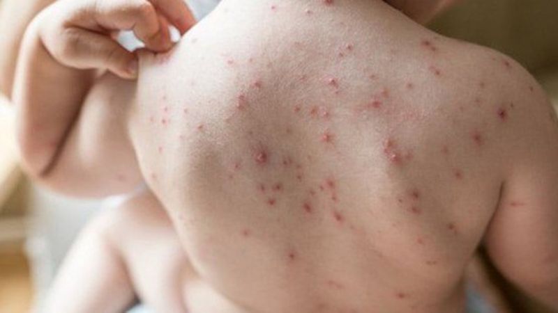 Tìm hiểu về vắc xin thủy đậu cho trẻ 9 tháng tuổi 1
