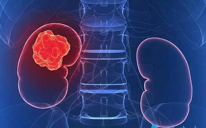 tinh-trang-benh-nhan-ung-thu-ngay-cang-tre-hien-nay 2.jpg