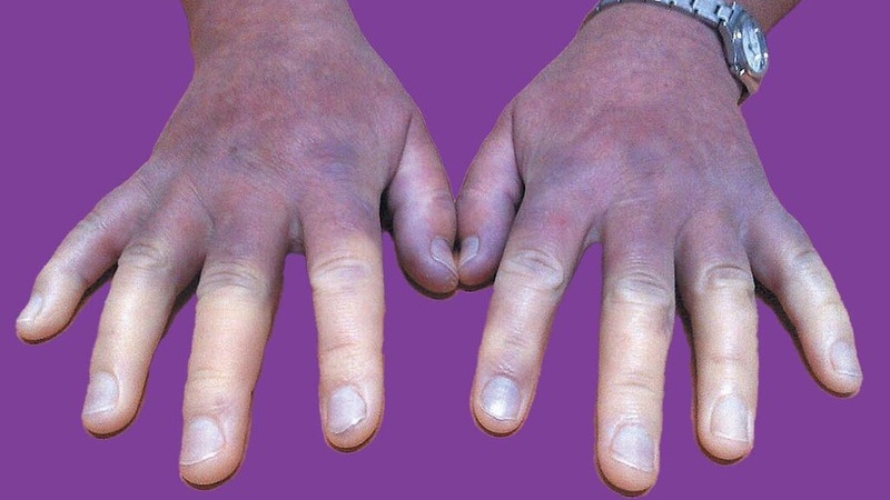 Tổng hợp các dấu hiệu tràn dịch màng phổi bạn không nên bỏ qua 3