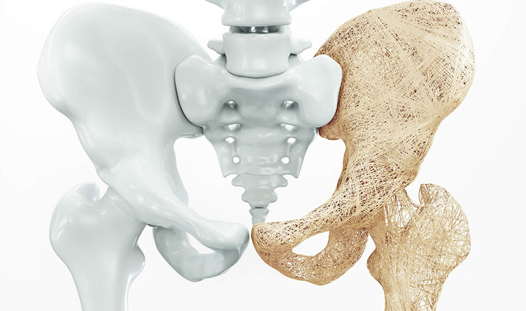 Tổng hợp những điều cần biết về loãng xương độ 2 1