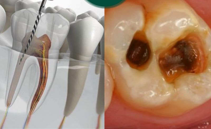 Tổng quan về tái tạo cùi răng và các điểm cần lưu ý 2