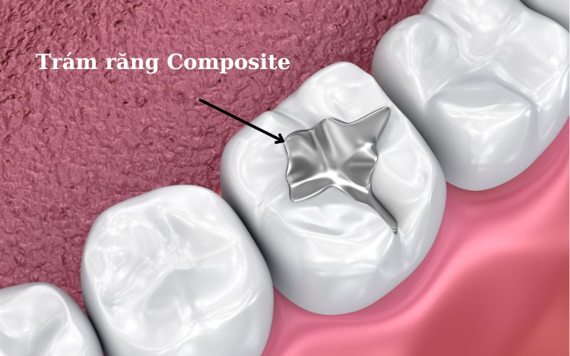 Trám răng cửa bao nhiêu tiền? Chi tiết quy trình trám răng 3